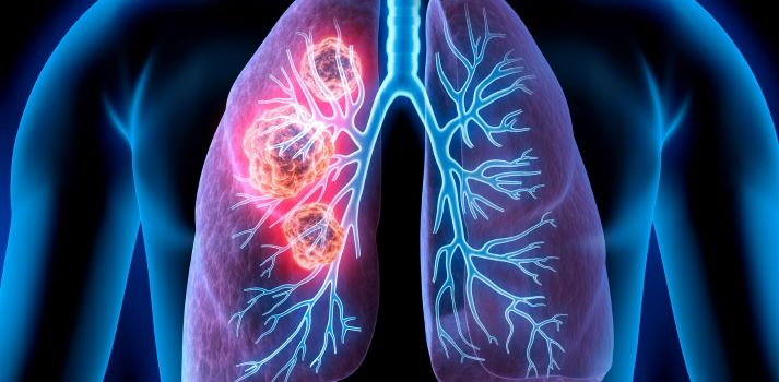 Lungenkrebs Risiken Symptome Therapien Prognose